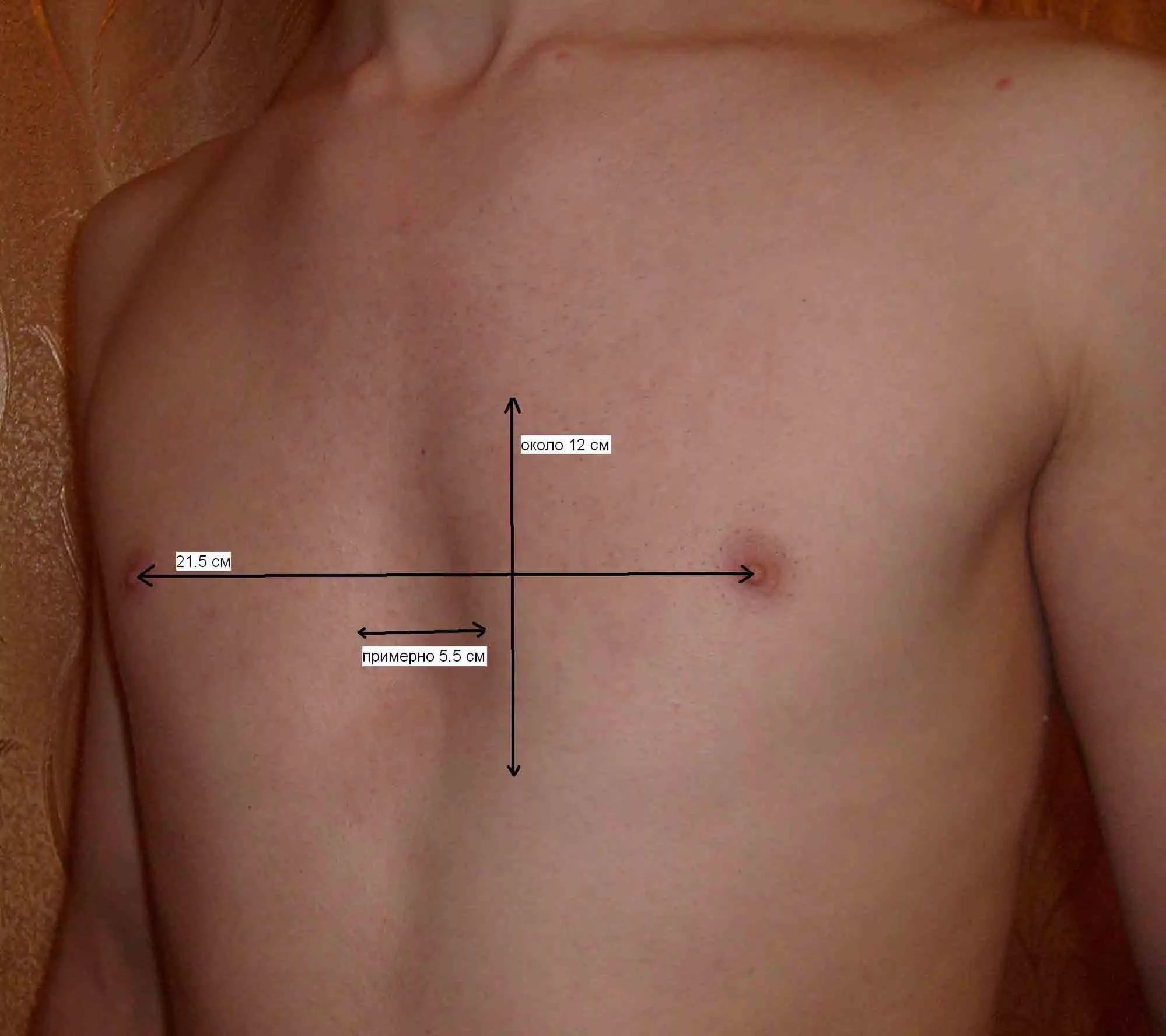воронкообразная грудь у мужчин фото 46